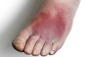 Elderly Person's Foot with Cellulitis 