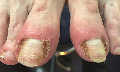 Ingrowing toenail in elderly woman's feet