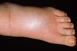oedema in swollen foot of woman