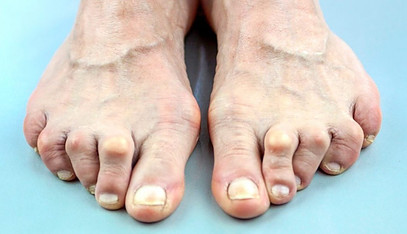 Rheumatoid arthritis in elderly woman's foot