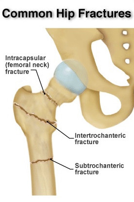 Common types of hip fractures in the elderly