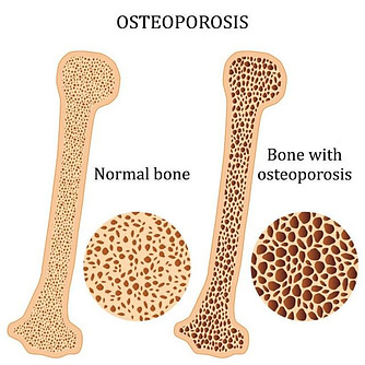 Osteoporosis as we get older