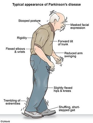 Parkinson disease is common in the elderly and seniors