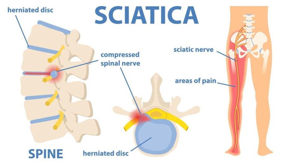 Sciatica nerve pain symptoms